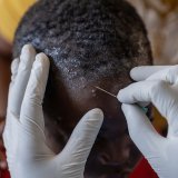 La variole du singe ou mpox est une maladie virale provoquant fièvre, douleurs musculaires et lésions cutanées (archives). KEYSTONE/EPA/MOISE KASEREKA
